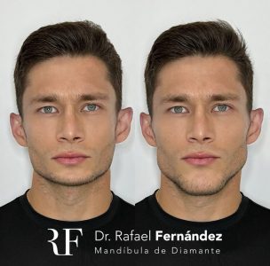 masculinización facial