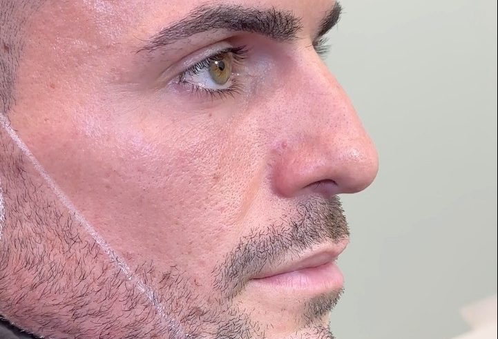 Mandíbula de Diamante - Masculinización Facial