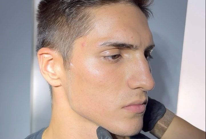 Masculinización Facial