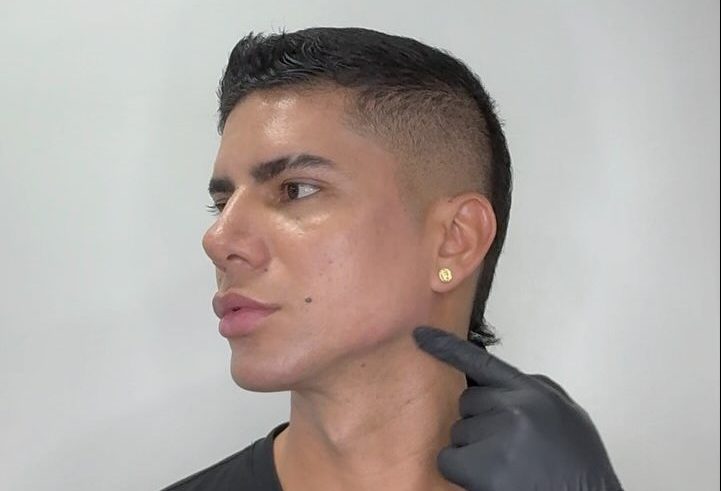 Masculinización Facial