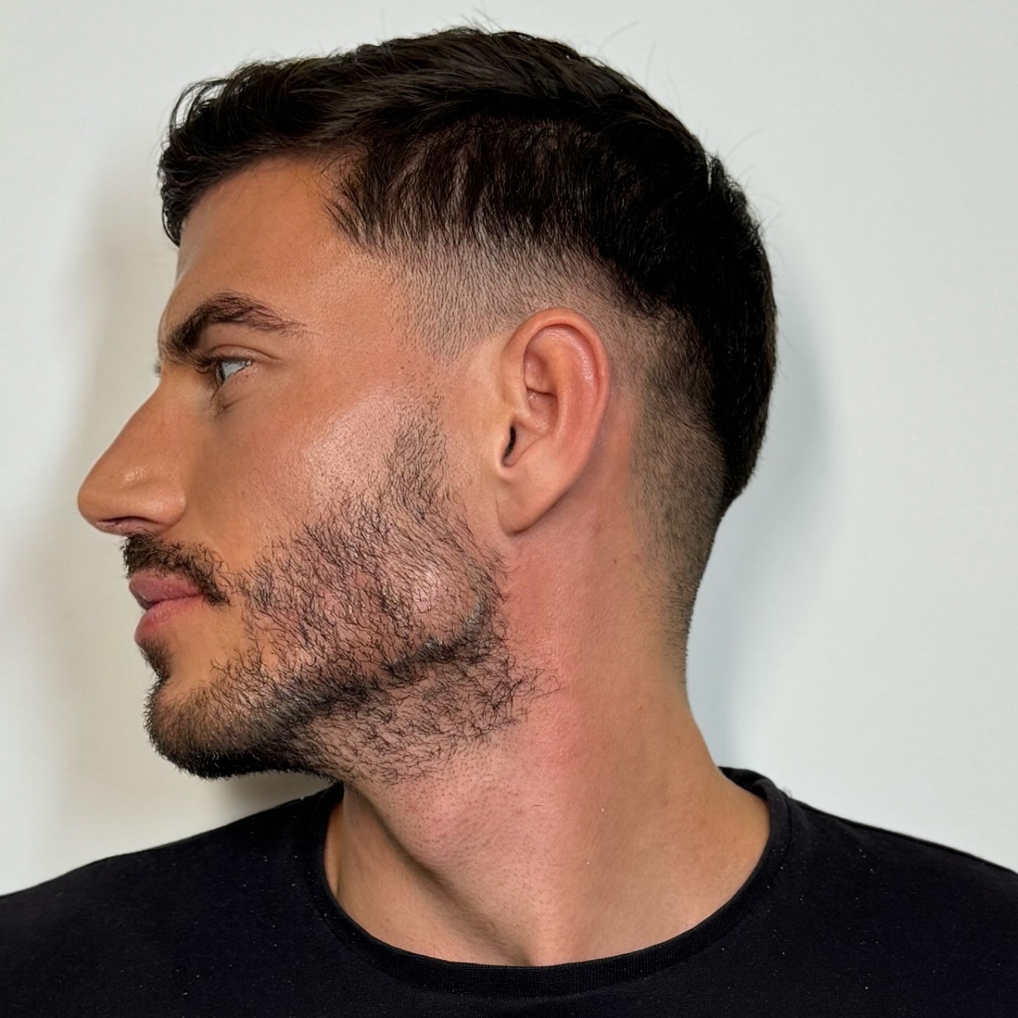 Mandíbula de Diamante - Masculinización Facial