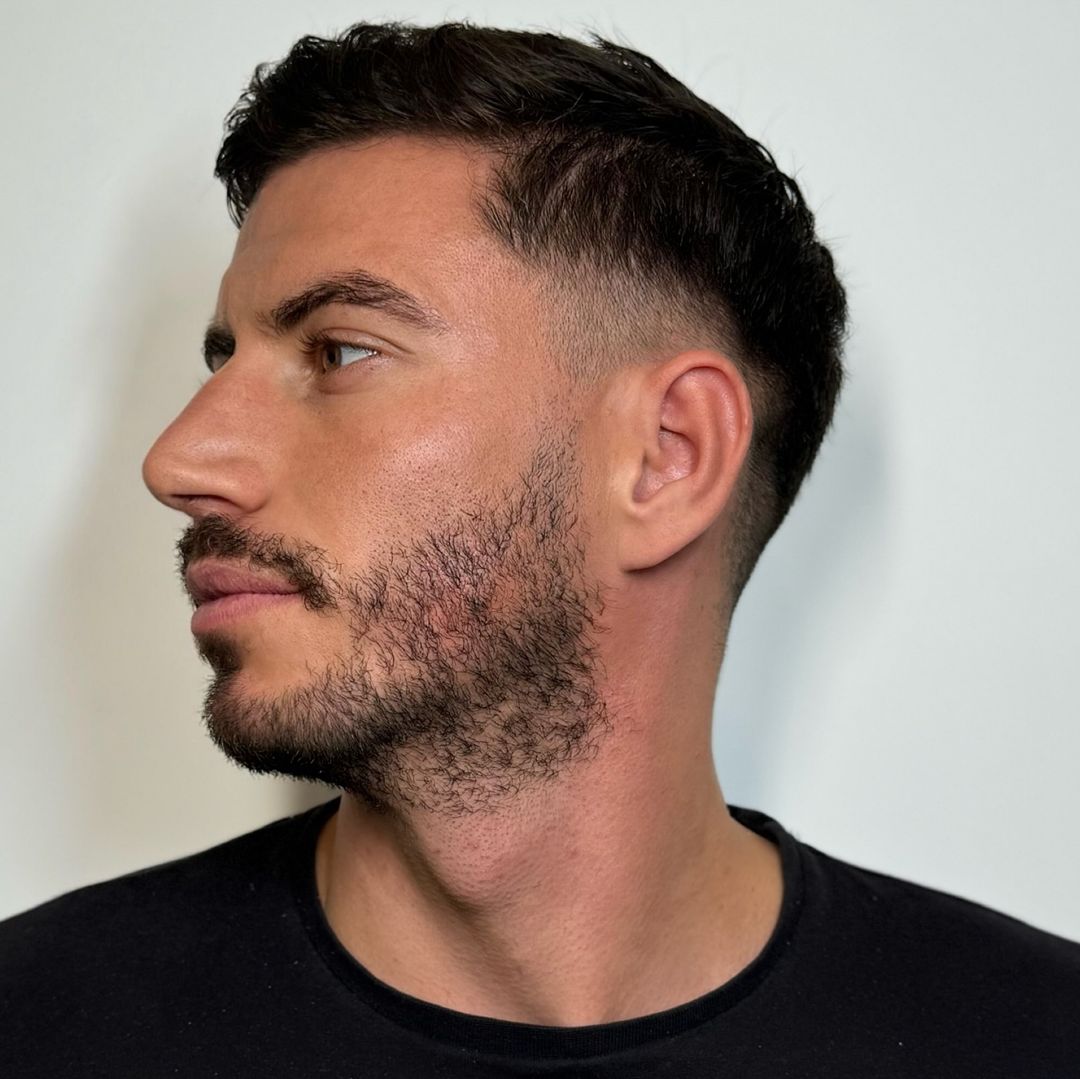 Mandíbula de Diamante - Masculinización Facial