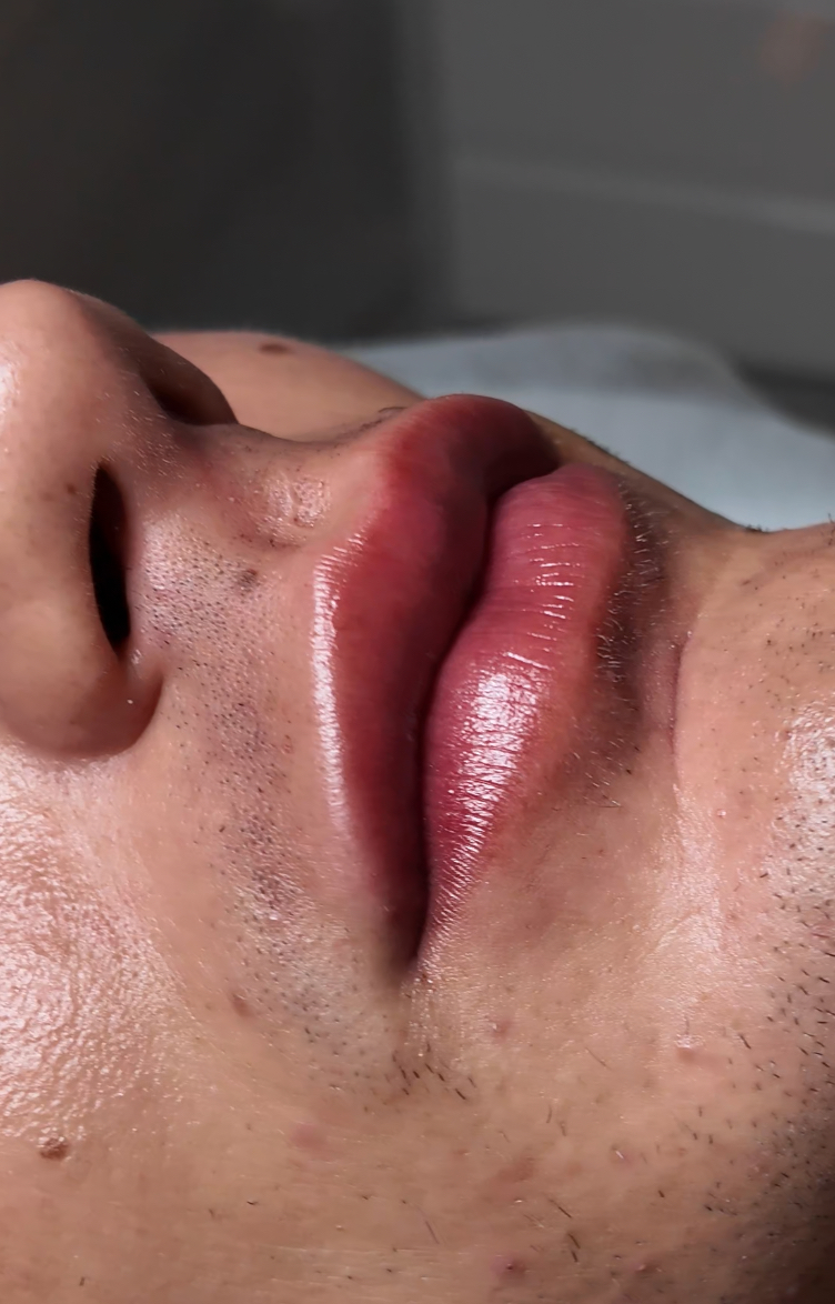 aumento de labios