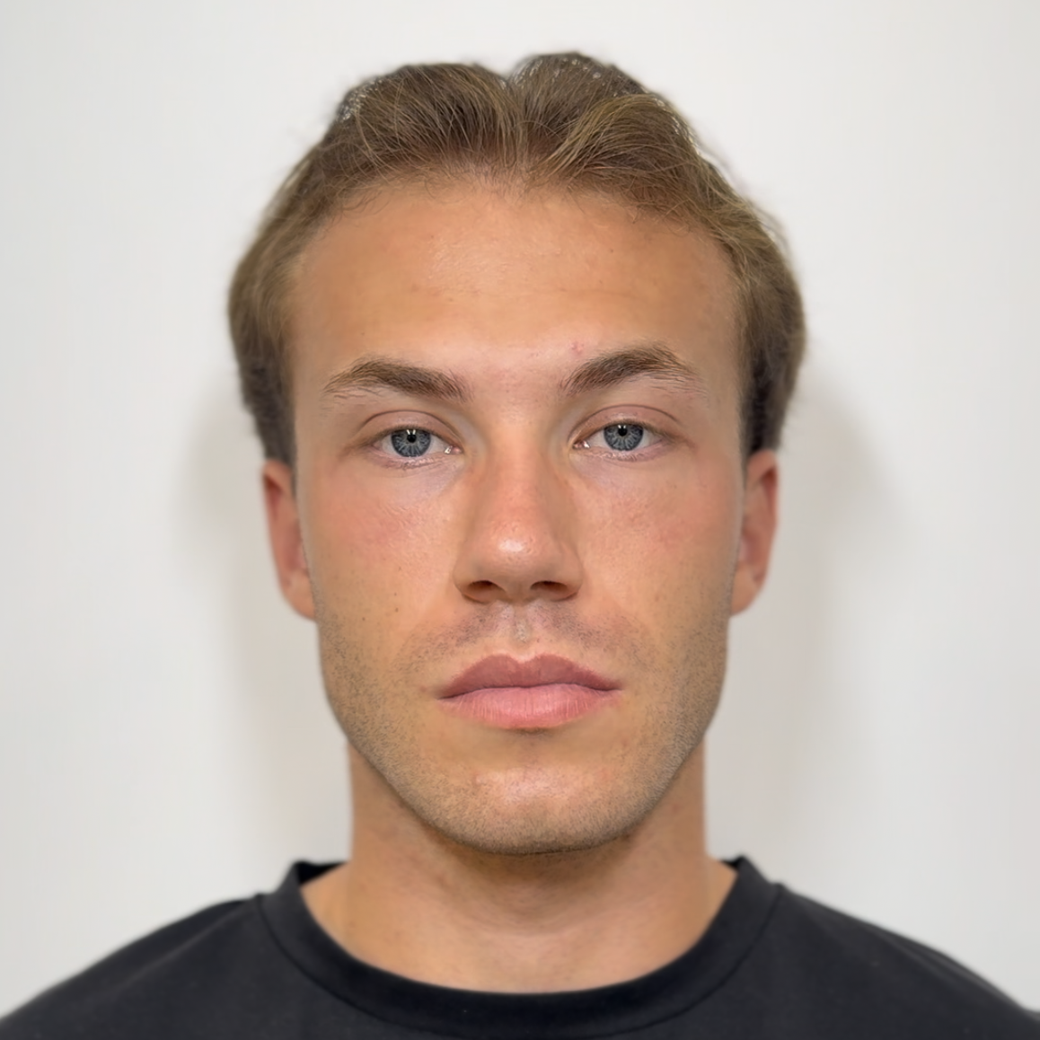 Mandíbula de Diamante - Masculinización Facial