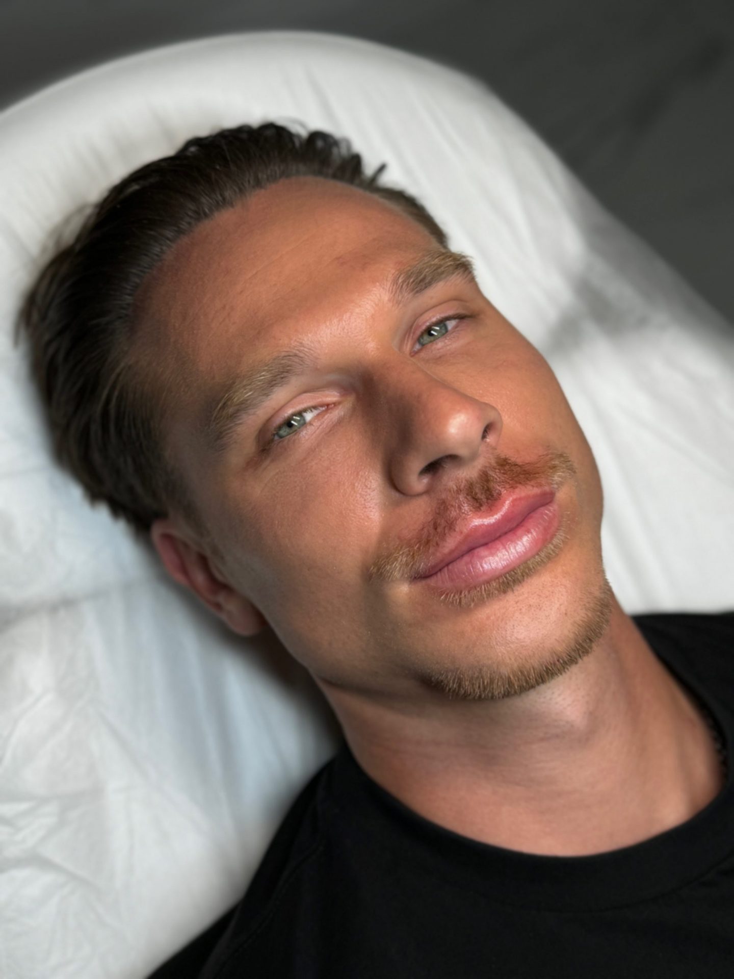 tratamiento para eliminar bolsas y ojeras