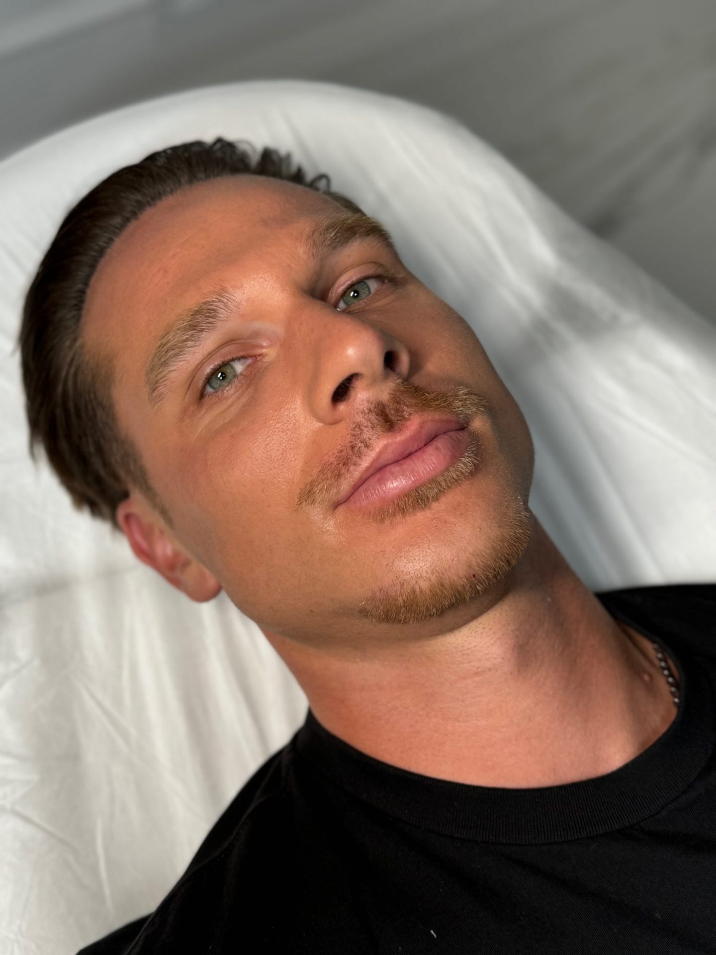 tratamiento para eliminar bolsas y ojeras