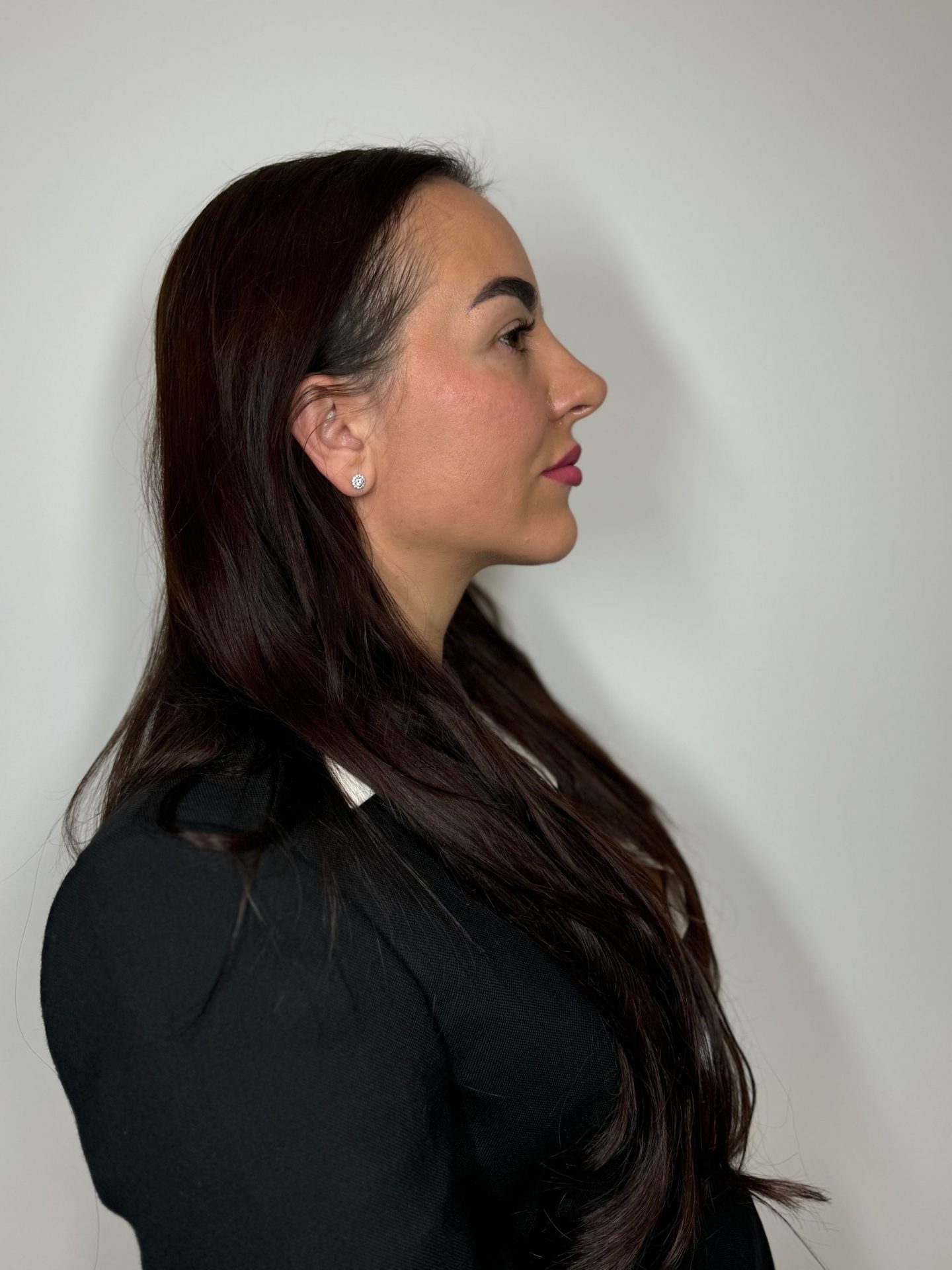 Rinomodelación sin Cirugía