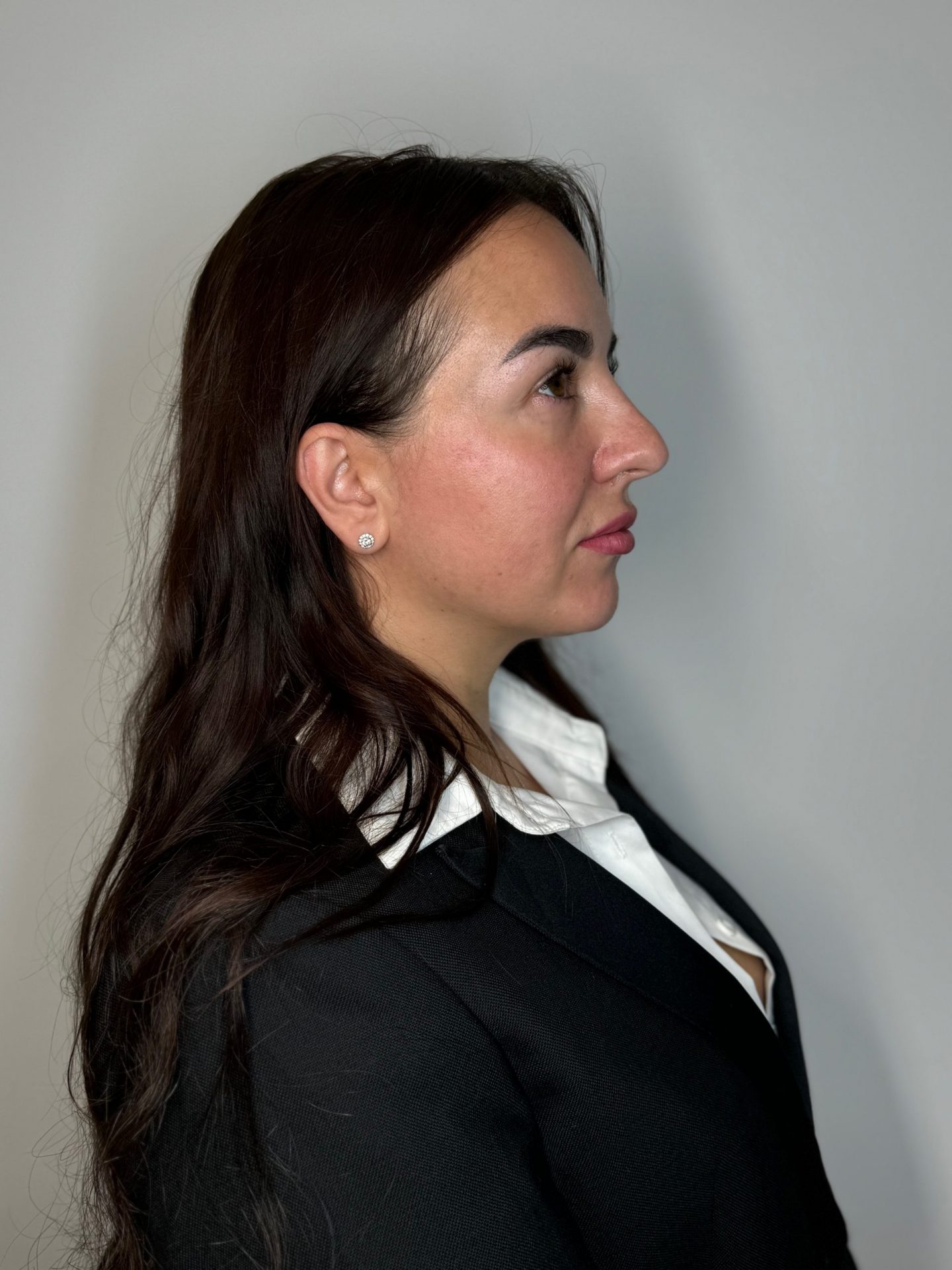 Rinomodelación sin Cirugía