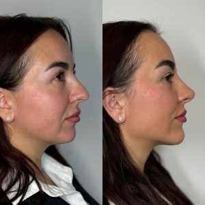armonización facial