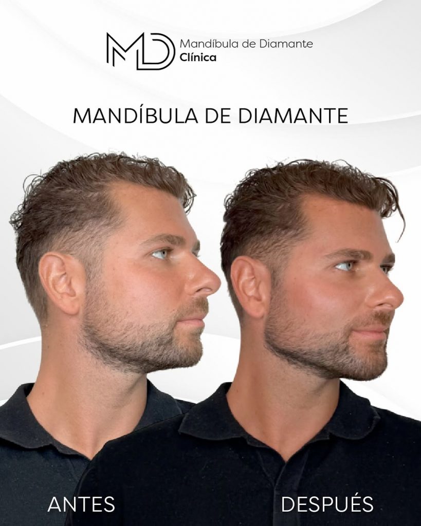 masculinizacion facial