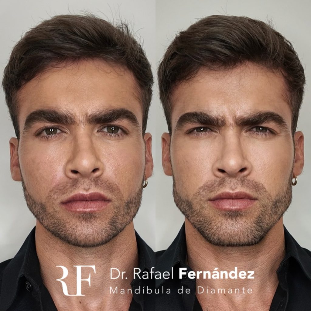 armonizacion facial