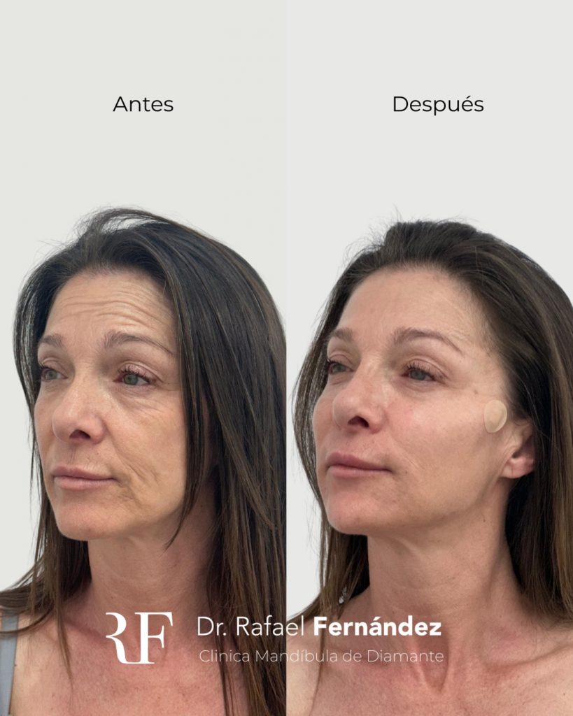 armonizacion facial