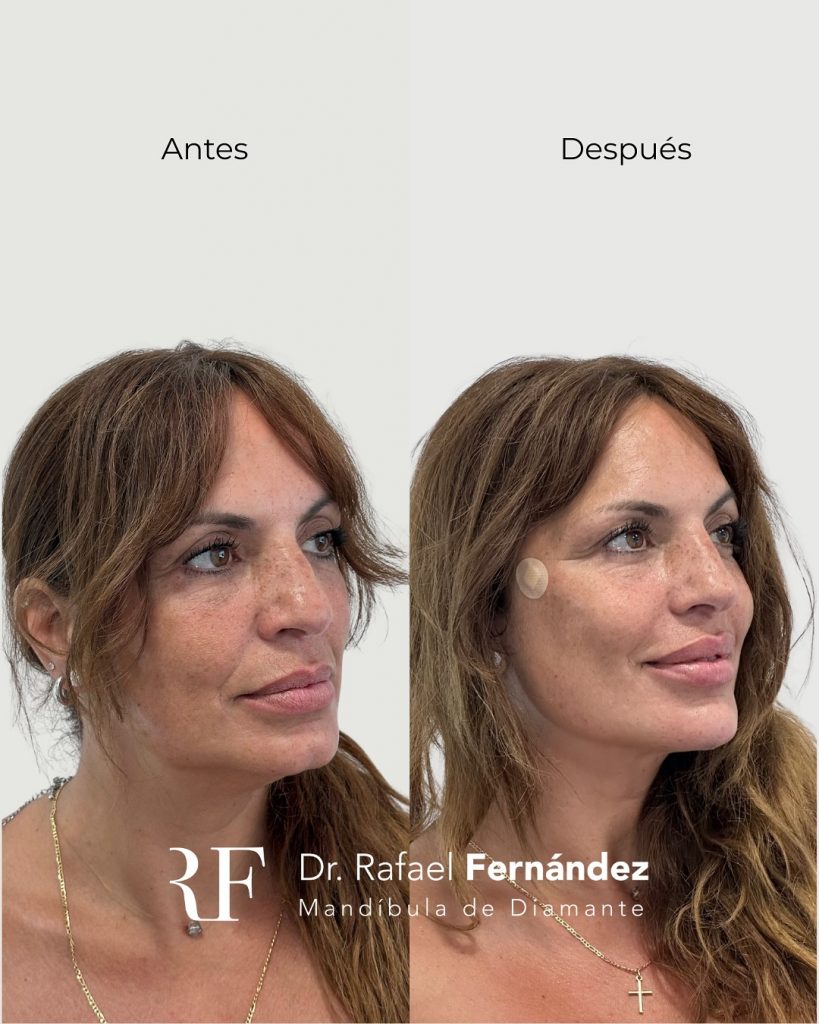 armonizacion facial