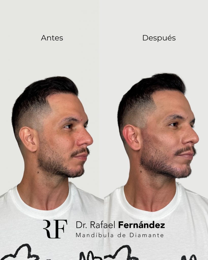 armonizacion facial