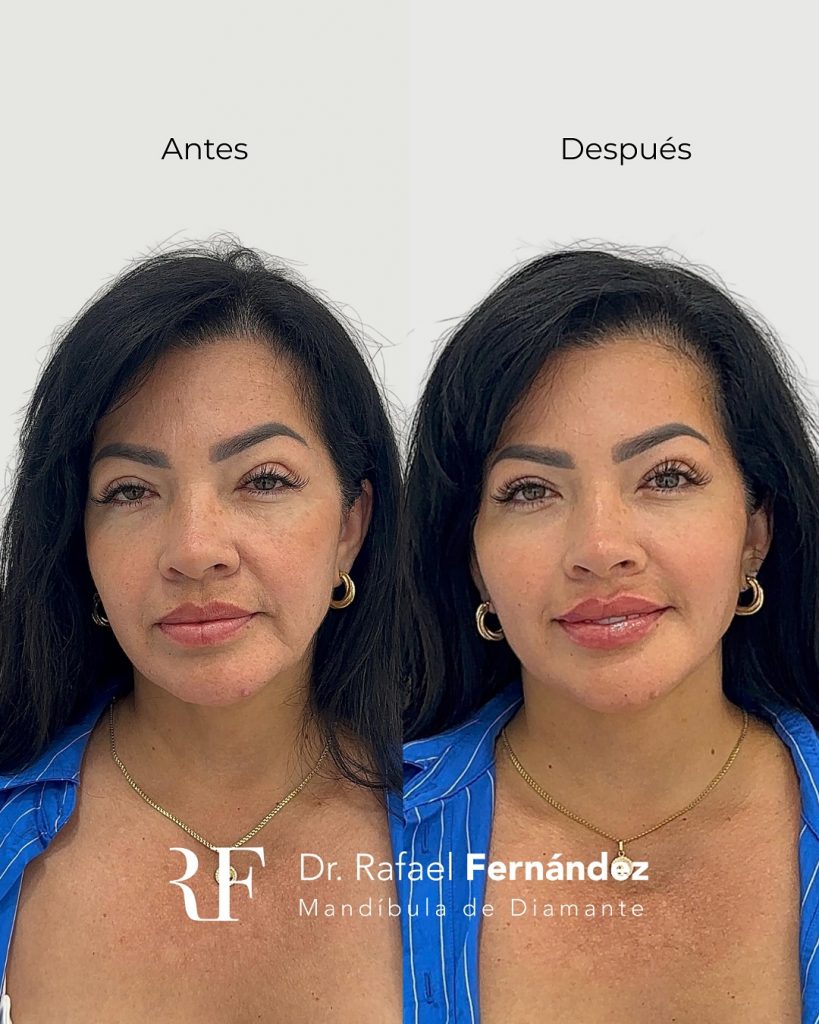 armonizacion facial
