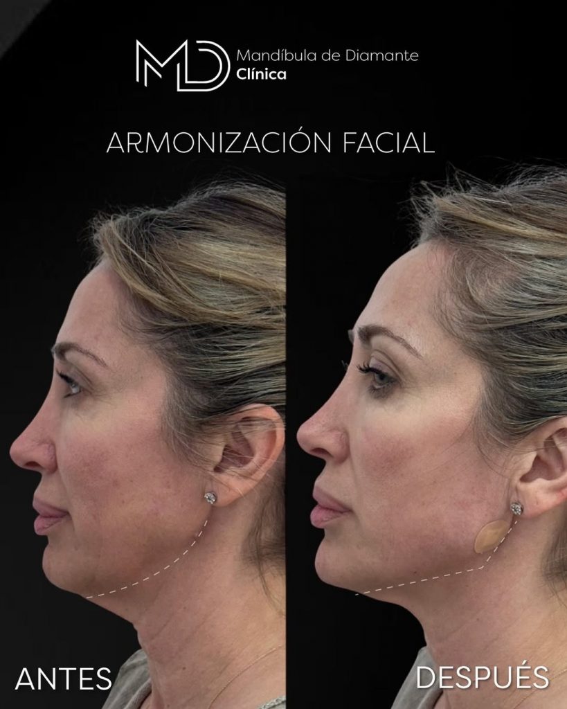 armonización facial barcelona