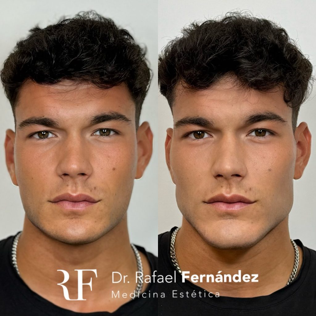 armonizacion facial