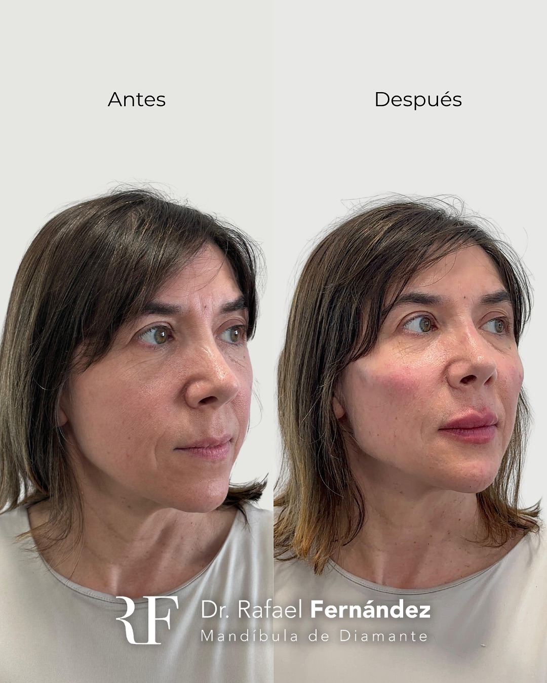 Bioestimuladores de colágeno