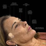 armonización facial