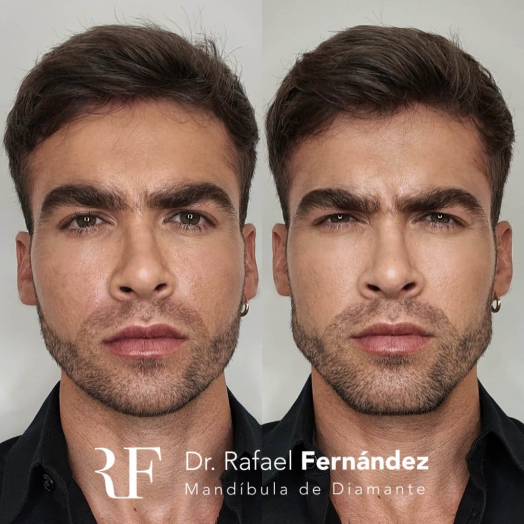 armonización facial