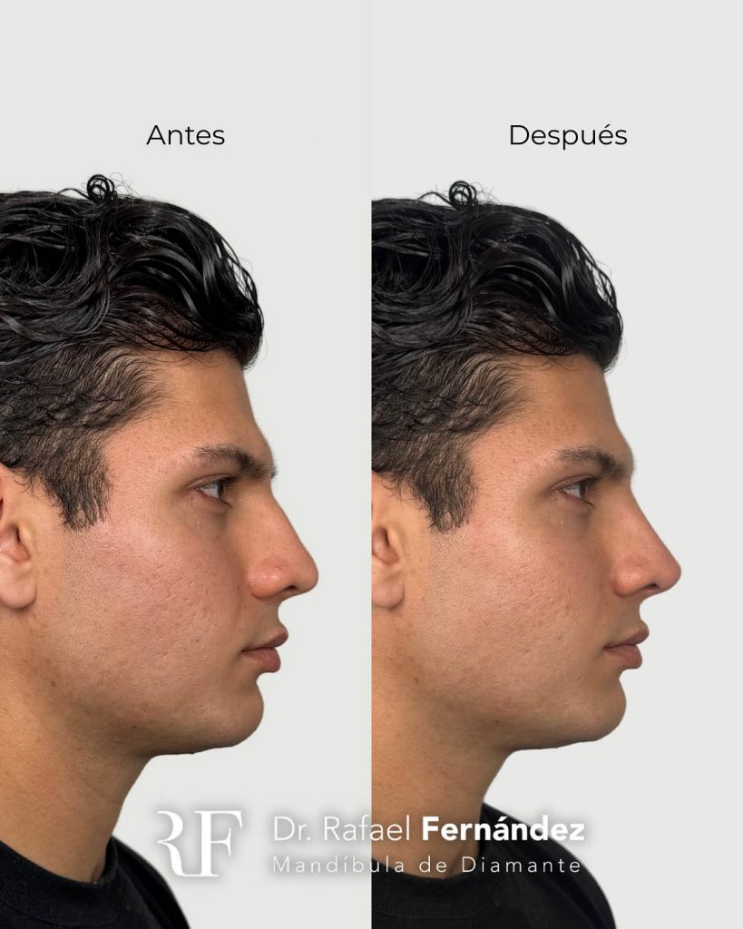 armonización facial