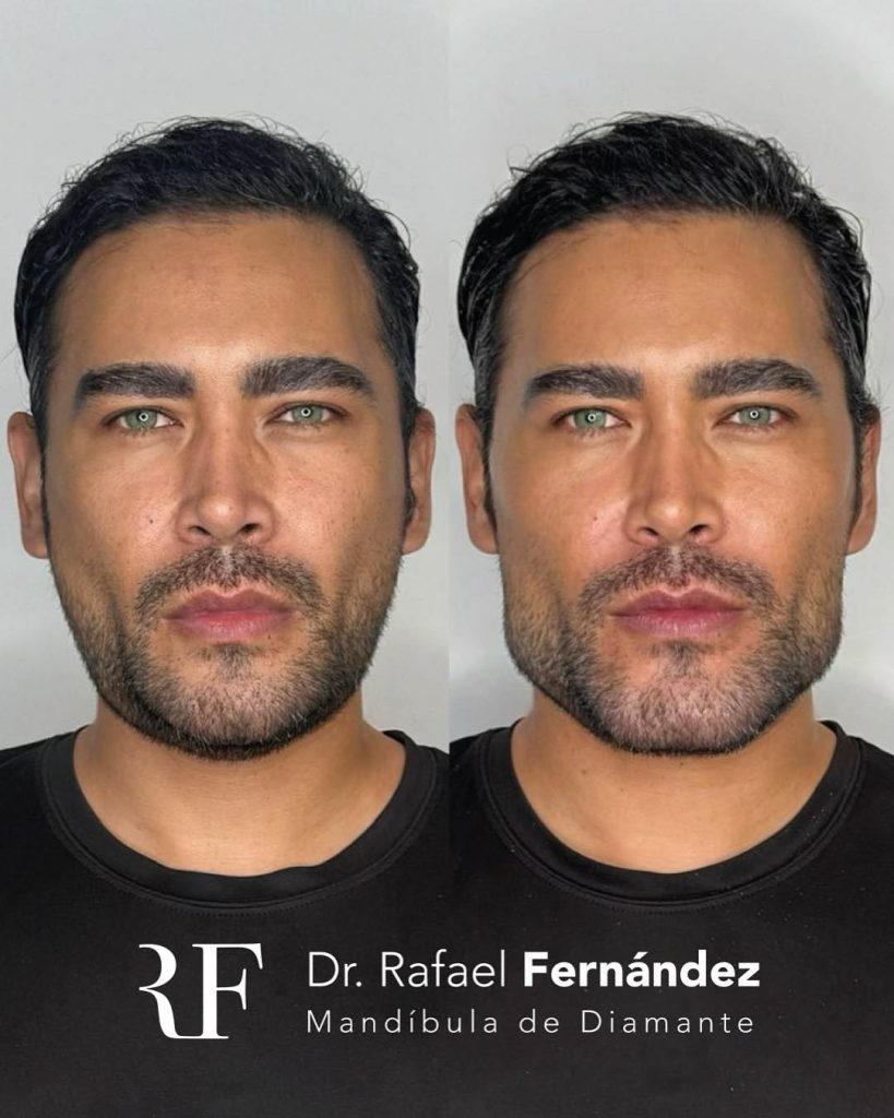 armonización facial