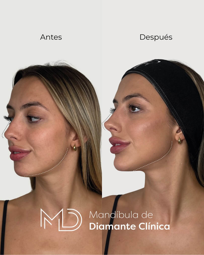 armonización facial