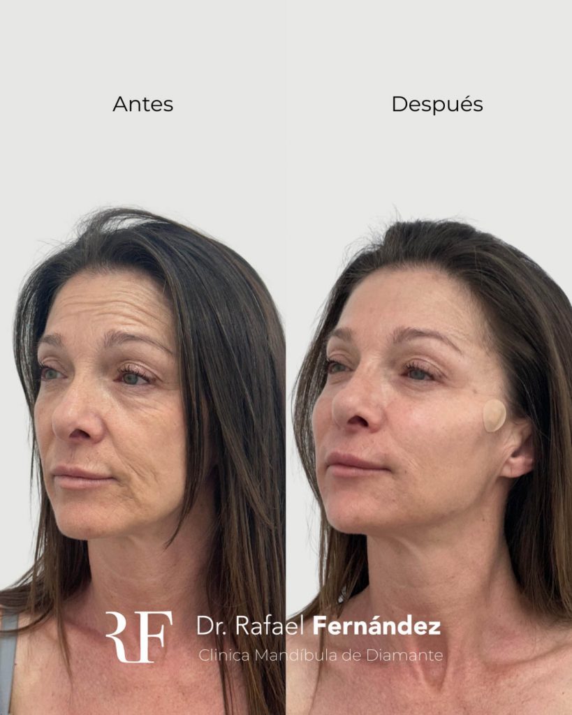 armonización facial