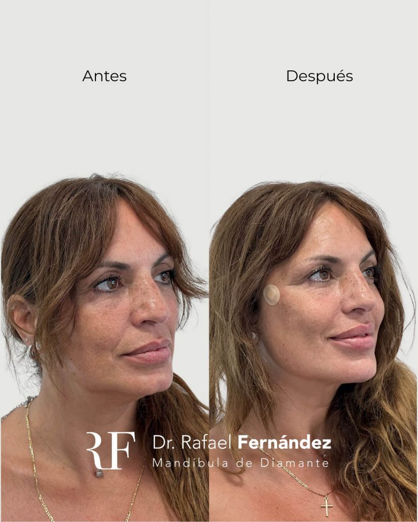 armonización facial