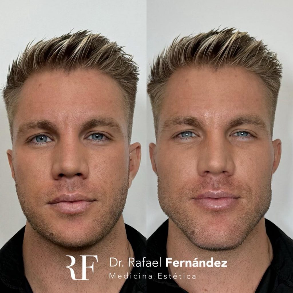 armonización facial