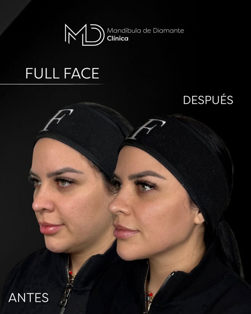 armonización facial madrid