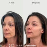 Lifting Sin Cirugía Barcelona