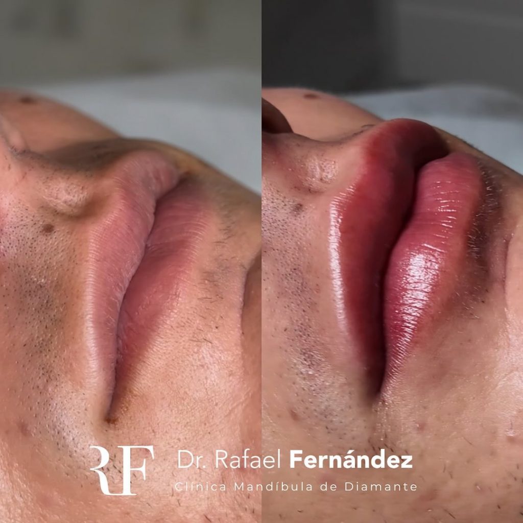 Aumento de labios hombre antes y despues