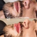 Aumento de labios hombre antes y despues