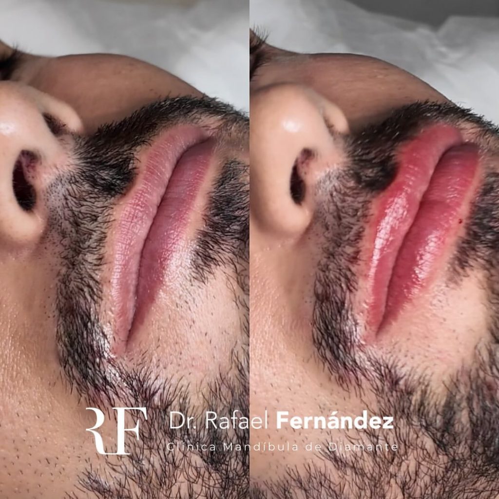 Aumento de labios hombre antes y despues