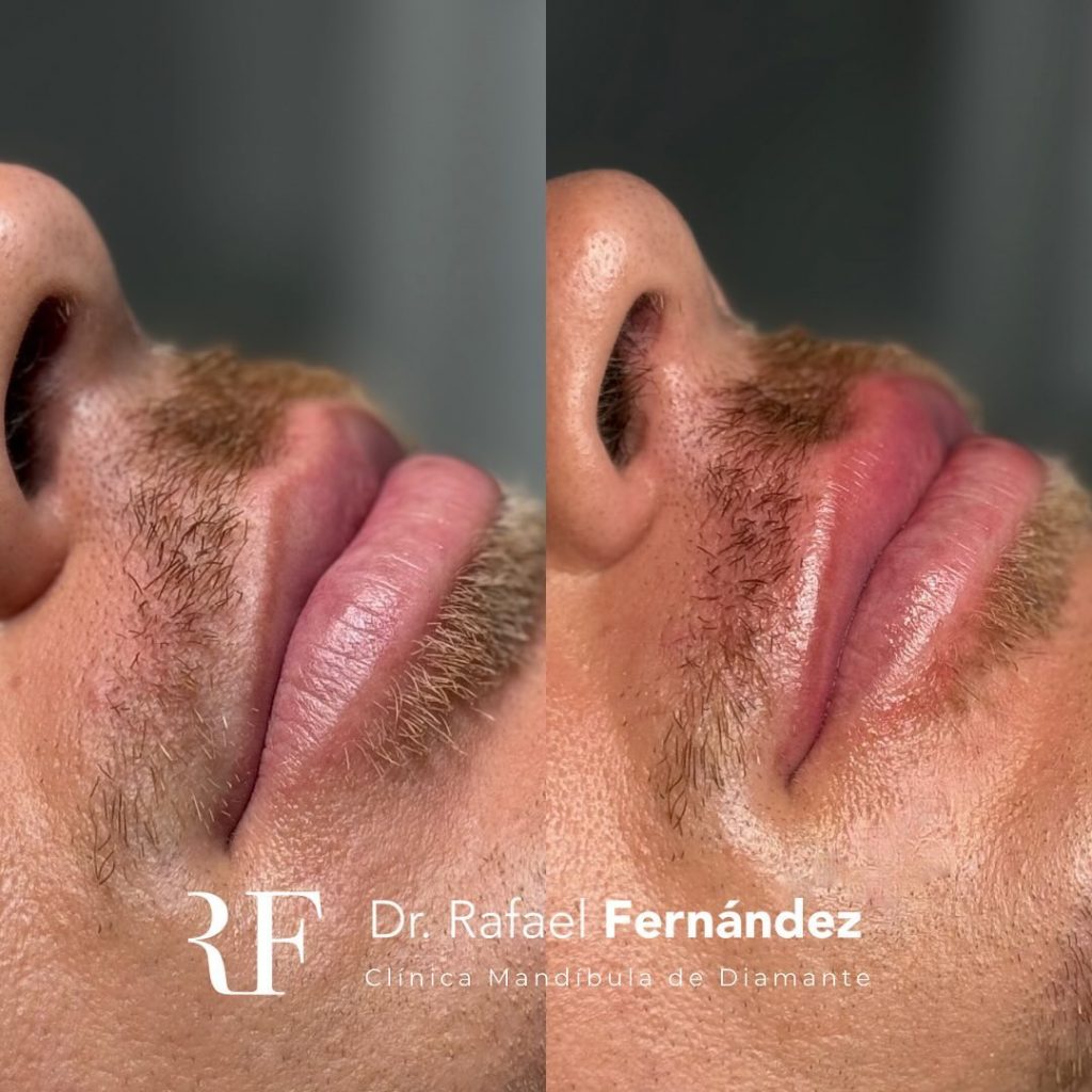 Aumento de labios hombre antes y despues