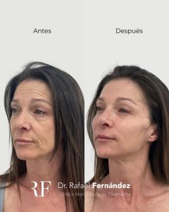 Rellenos faciales