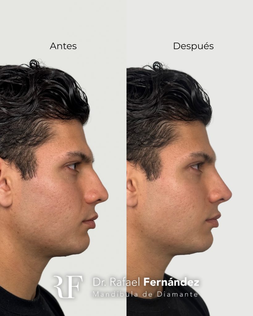 Retoque de Nariz sin Cirugía