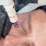 Rejuvenecimiento Facial con Láser en Barcelona