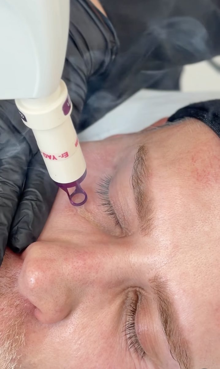 Rejuvenecimiento Facial con Láser en Barcelona