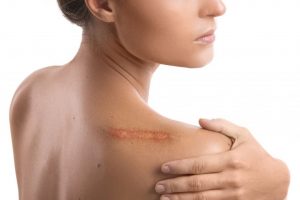 Tratamiento de Cicatrices y Queloides en Barcelona