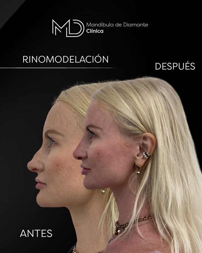 nose tip non-surgical rhinoplasty