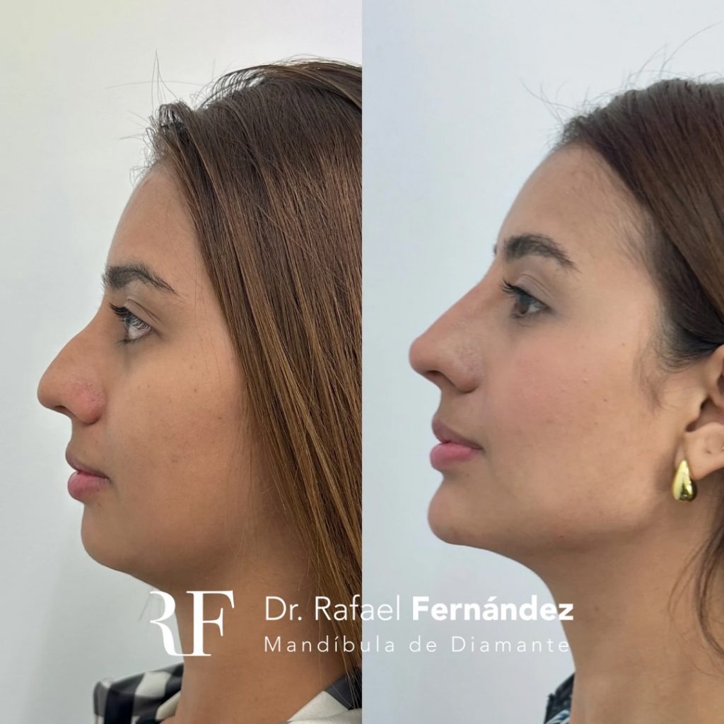 nose tip non-surgical rhinoplasty