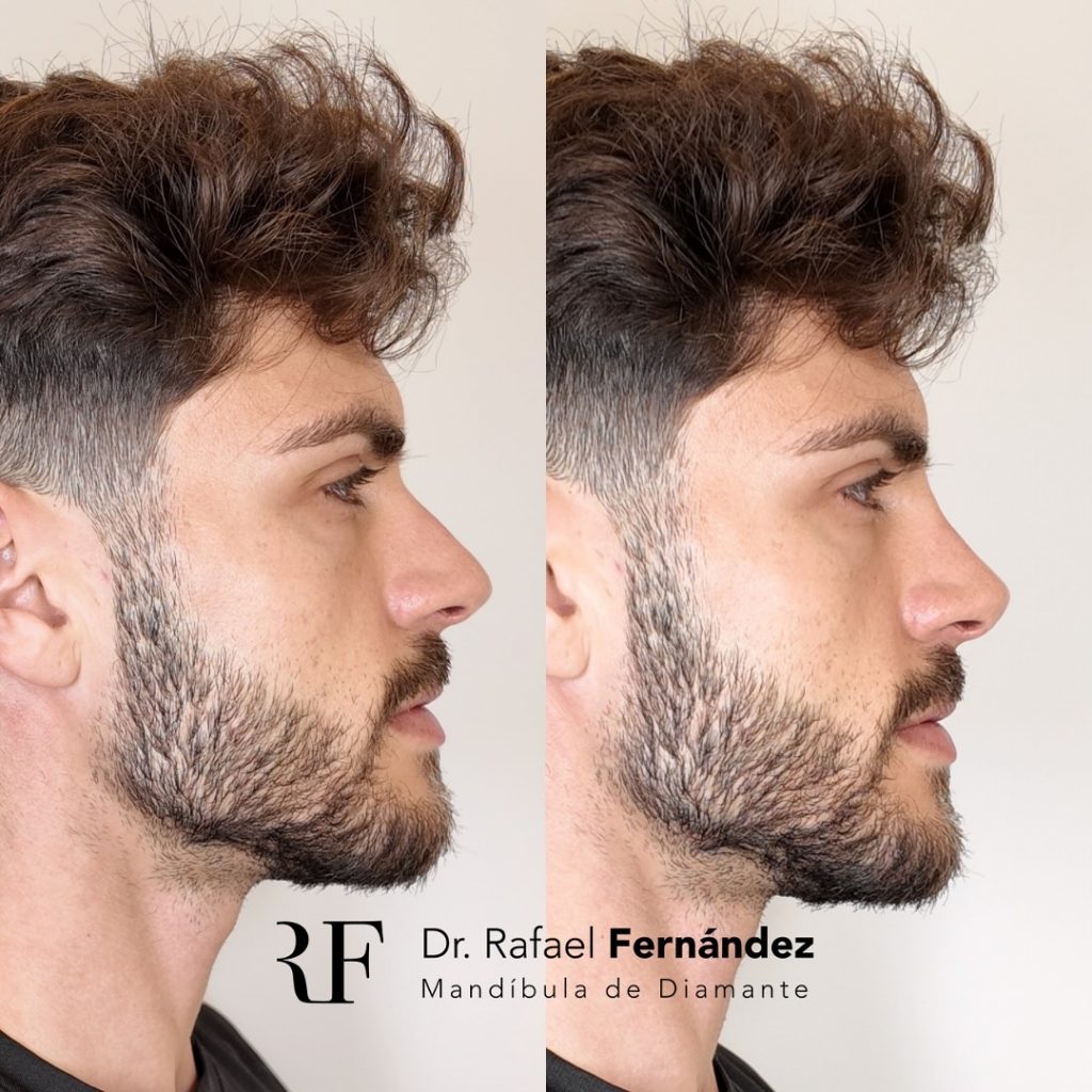 nose tip non-surgical rhinoplasty