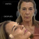tratamiento para la flacidez facial