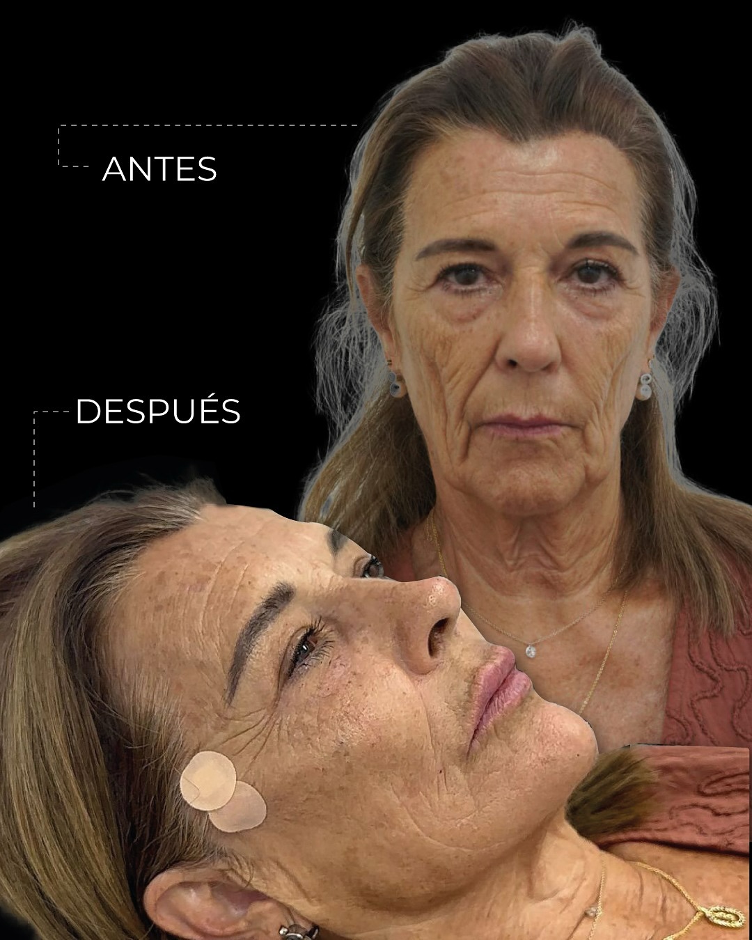 treatment for facial sagging