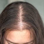 Tratamiento para la Caída del Pelo en Mujeres
