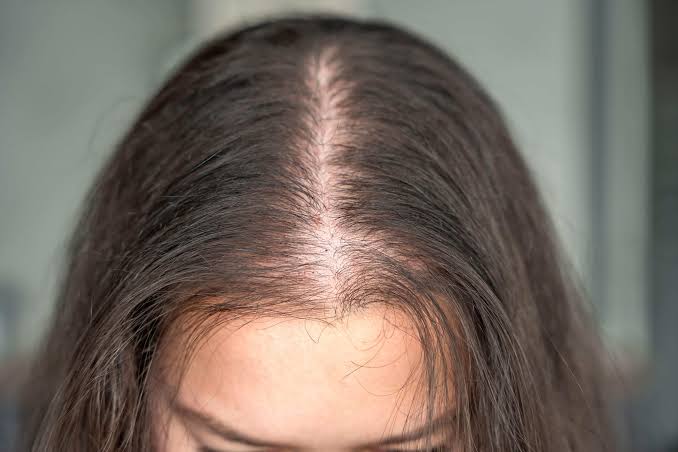 Treatment for Hair Loss in Women