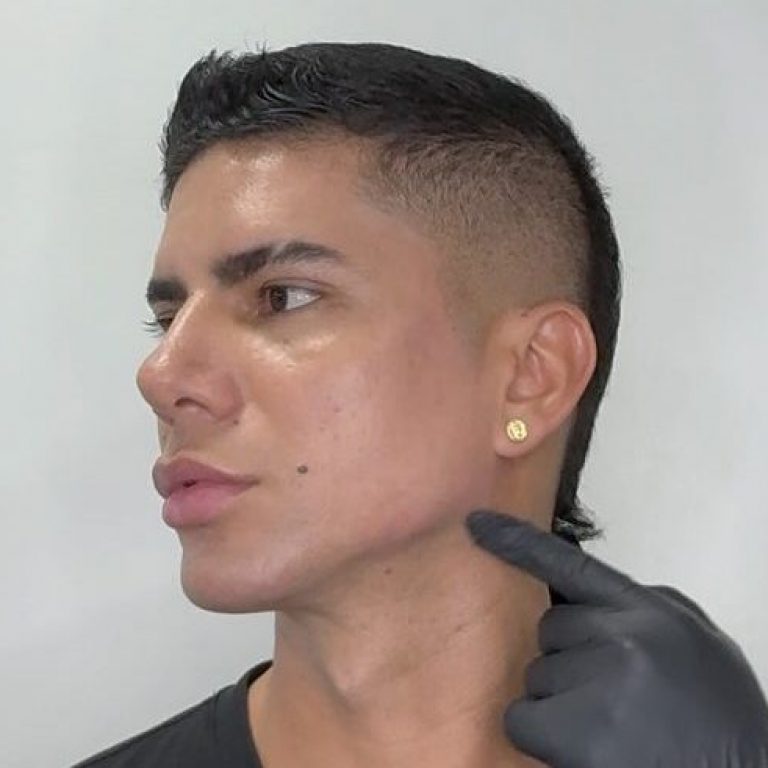 Masculinización Facial