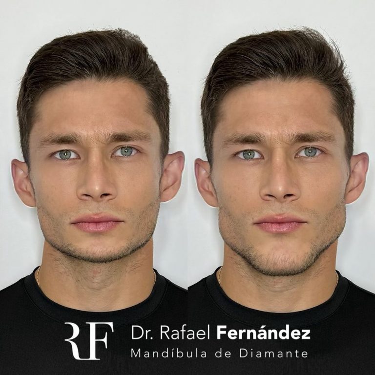 masculinización facial